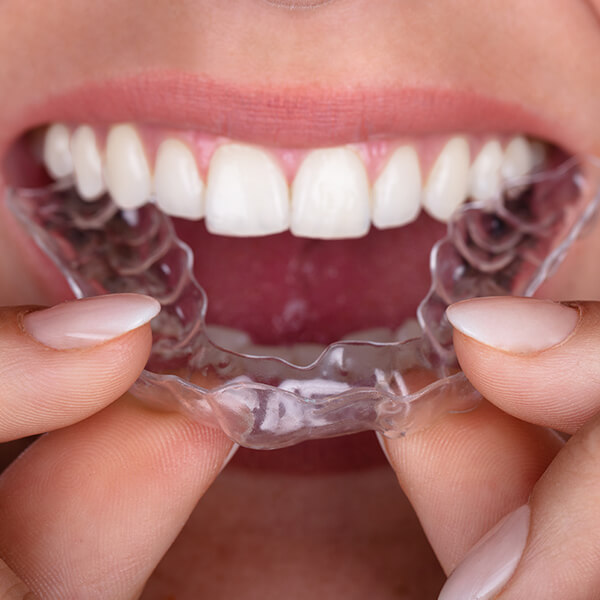 A close-up shot of a woman placing clear aligners in her mouth