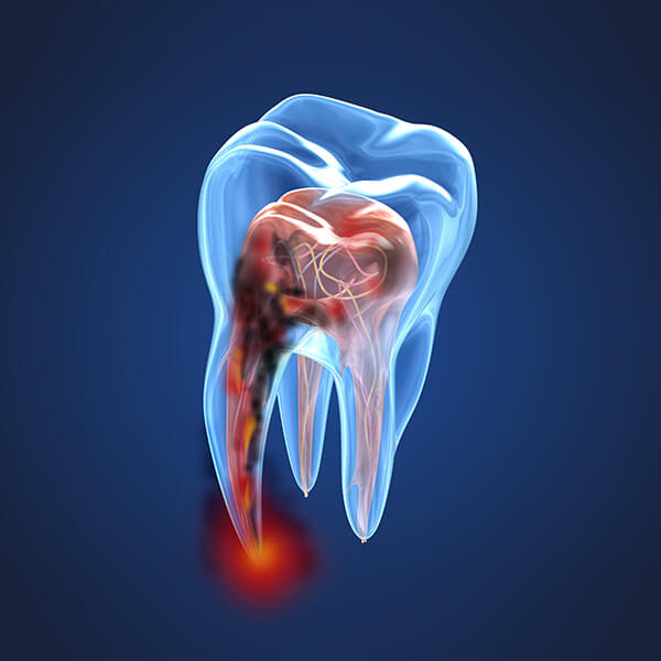 3D image of a root canal